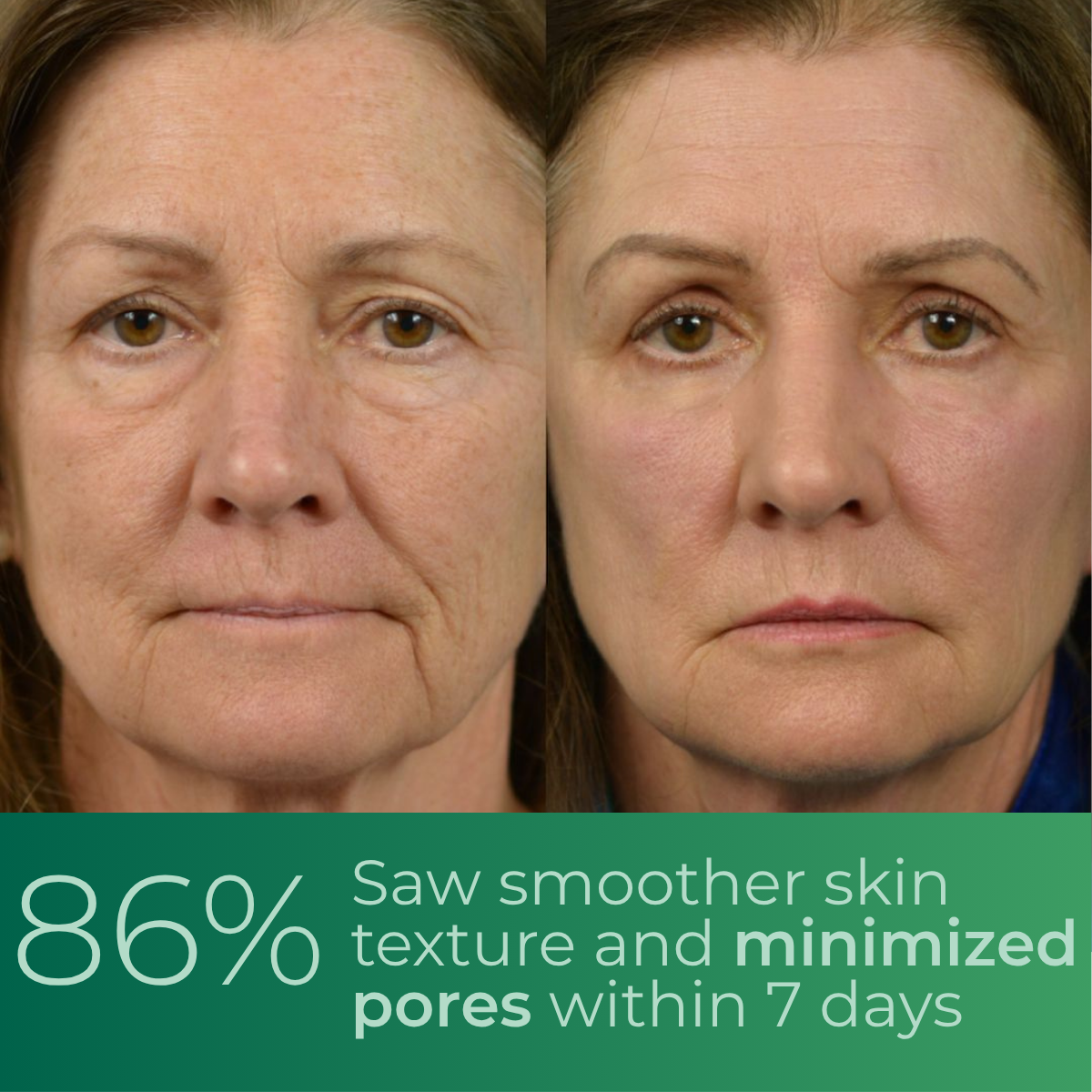Revessé™ - Smooth Wrinkles and Lift Sagging Skin with a Simple Cream