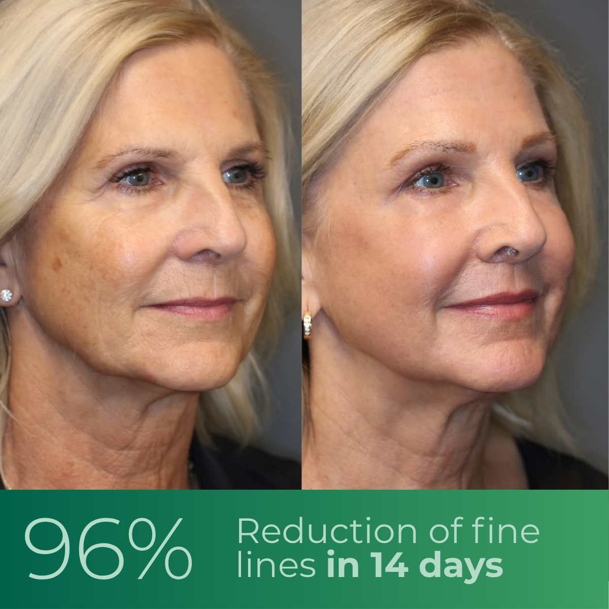The First PDRN Eye Care Serum that Regenerates Skin at the Cellular Level