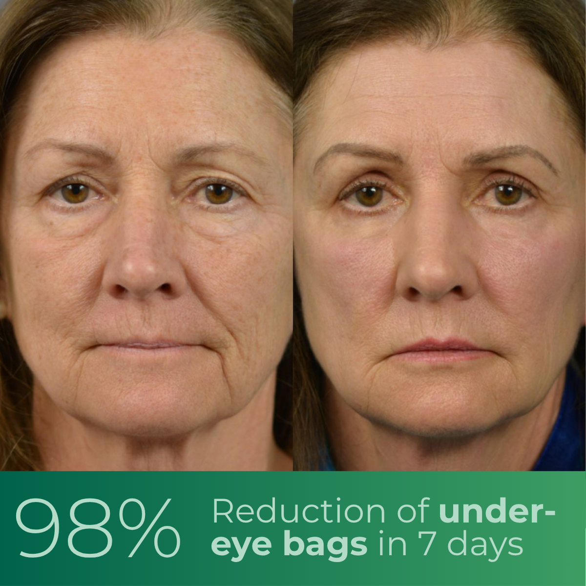 The First PDRN Eye Care Serum that Regenerates Skin at the Cellular Level